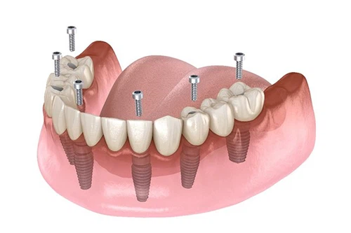 NiTi shape memory alloy NiTi shape memory alloy